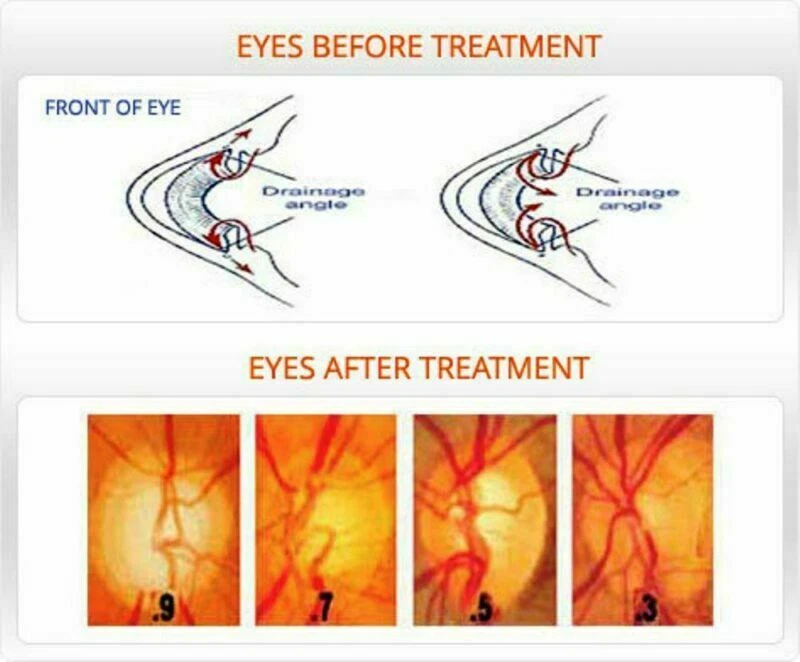 3X Eye Drops OFFICIAL USA Care Glaucoma Best For Eye Problem Cataract low price